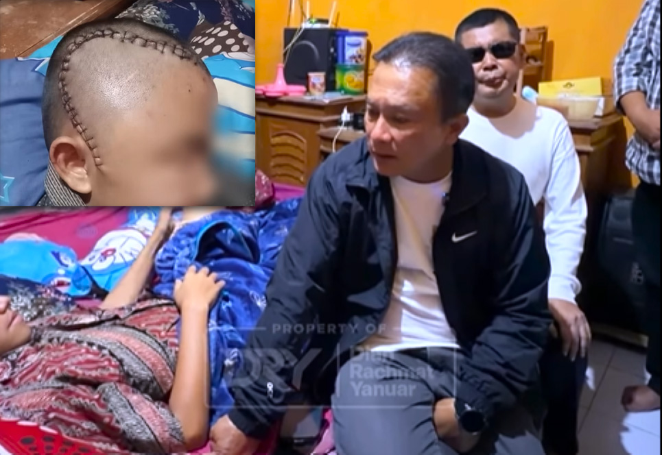 Viral Penganiayaan di Kuningan Siswa Kelas 9 Harus Operasi Kepala, Bupati Turun Tangan